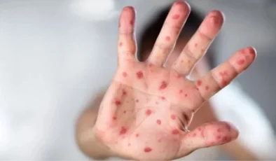 Uzmanından kızamık uyarısı: İstanbul kaynaklı ciddi bir salgın yaşadık